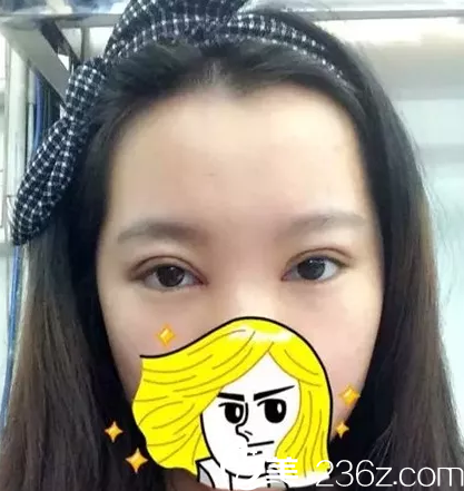 在玉林華美做雙眼皮手術(shù)后7天