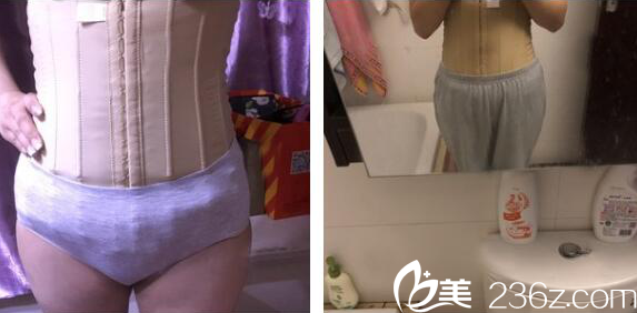 在深圳非凡醫(yī)院做完吸脂兩天了