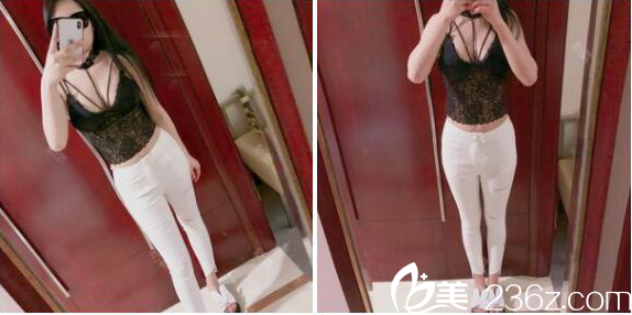 深圳非凡醫(yī)院腰腹部吸脂一個月效果展示