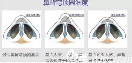 桂林葉氏嘉美隆鼻手術(shù)貴不貴？近期整形優(yōu)惠價(jià)格表公開隆鼻手術(shù)6800元起