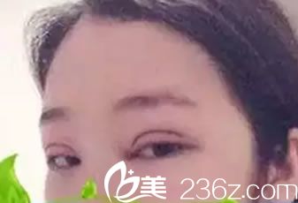 桂美人做雙眼皮和開眼角即刻<span style= 桂美人做雙眼皮和開眼角即刻<span style=