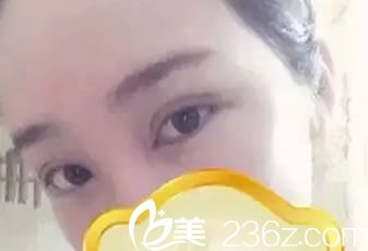 做完雙眼皮和開眼角3天恢復(fù)照 做完雙眼皮和開眼角3天恢復(fù)照