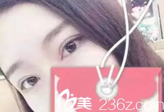 桂美人整形割雙眼皮開眼角<span style= 桂美人整形割雙眼皮開眼角<span style=