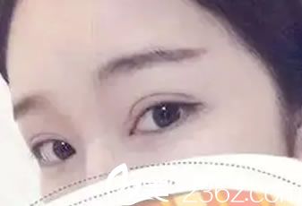 做完雙眼皮12天恢復(fù)<span style= 做完雙眼皮12天恢復(fù)<span style=