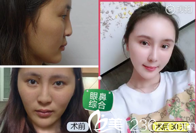 陳星雙眼皮隆鼻手術(shù)后效果