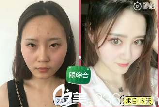 陳星雙眼皮做的好嗎？看案例