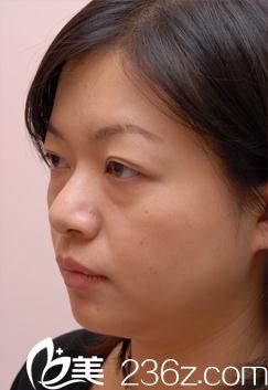 古山登隆玻尿酸注射前 古山登隆玻尿酸注射前