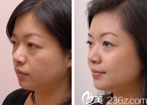古山登隆玻尿酸注射前后對比 古山登隆玻尿酸注射前后對比
