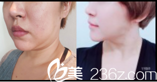 韓國dreamline吸脂塑形醫(yī)院面部吸脂+紗線提升 韓國dreamline吸脂塑形醫(yī)院面部吸脂+紗線提升