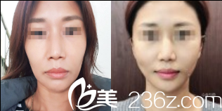 韓國dreamline吸脂塑形醫(yī)院雙線提升 韓國dreamline吸脂塑形醫(yī)院雙線提升