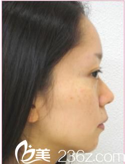 隆鼻術(shù)前 隆鼻術(shù)前