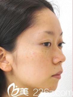 隆鼻術(shù)前 隆鼻術(shù)前