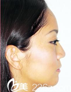 我的日本混血整形體驗(yàn)---自由之丘佐藤英明醫(yī)生做的隆鼻術(shù)前后效果對比