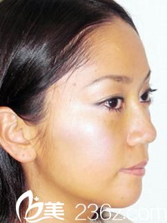 隆鼻術(shù)后 隆鼻術(shù)后