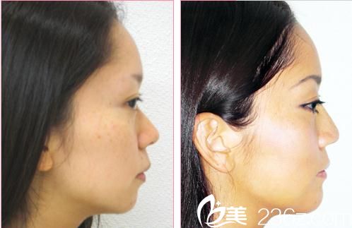 隆鼻術(shù)前后對比