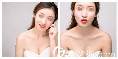 進口曼托假體隆胸素人體驗分享：找無錫施爾美呂韓偉醫(yī)生僅1個月就恢復(fù)了