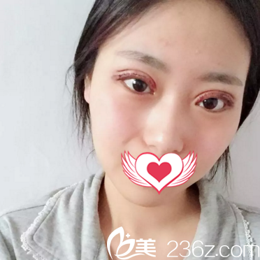 在沈陽美萊割雙眼皮術(shù)后天 在沈陽美萊割雙眼皮術(shù)后天