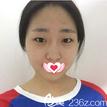 割雙眼皮術(shù)前照 割雙眼皮術(shù)前照