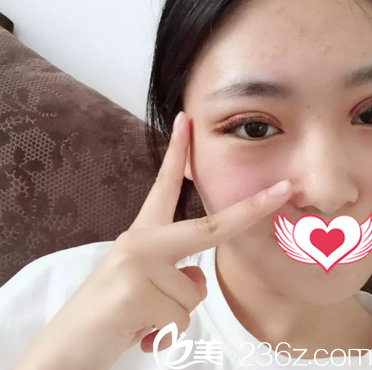 割雙眼皮術(shù)后第5天<span style= 割雙眼皮術(shù)后第5天<span style=