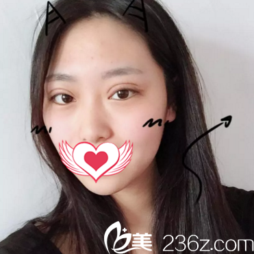 做雙眼皮整形術(shù)后一周拆線 做雙眼皮整形術(shù)后一周拆線