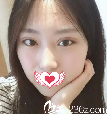 割雙眼皮術(shù)后半個(gè)月<span style= 割雙眼皮術(shù)后半個(gè)月<span style=