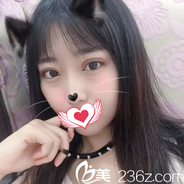 沈陽美萊做雙眼皮怎么樣？醫(yī)生給我做的切開雙眼皮術(shù)后2個月恢復(fù)效果圖