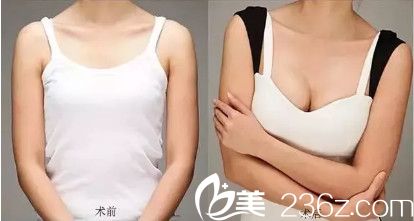 割雙眼皮手術(shù)要多少錢(qián)?廊坊韓譽(yù)國(guó)都年終整形優(yōu)惠價(jià)只要799元