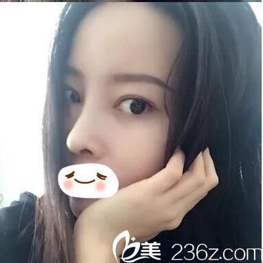 武漢愛美匯鼻綜合術(shù)后半個(gè)月效果 武漢愛美匯鼻綜合術(shù)后半個(gè)月效果