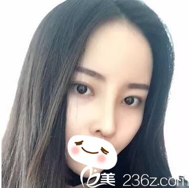 瞧了我鼻綜合術(shù)后1-7天的照片就曉得武漢愛美匯整形醫(yī)院李箭院長技術(shù)怎么樣