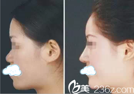 自體脂肪隆鼻 自體脂肪隆鼻