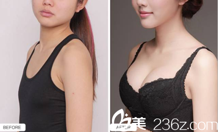 自體脂肪豐胸前后對比 自體脂肪豐胸前后對比