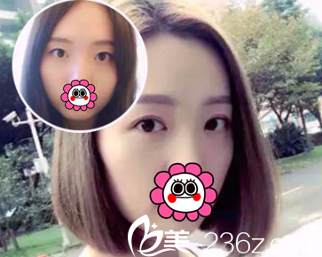 北京南加割雙眼皮多少錢(qián)？醫(yī)院眼整形價(jià)格表和案例搶先看