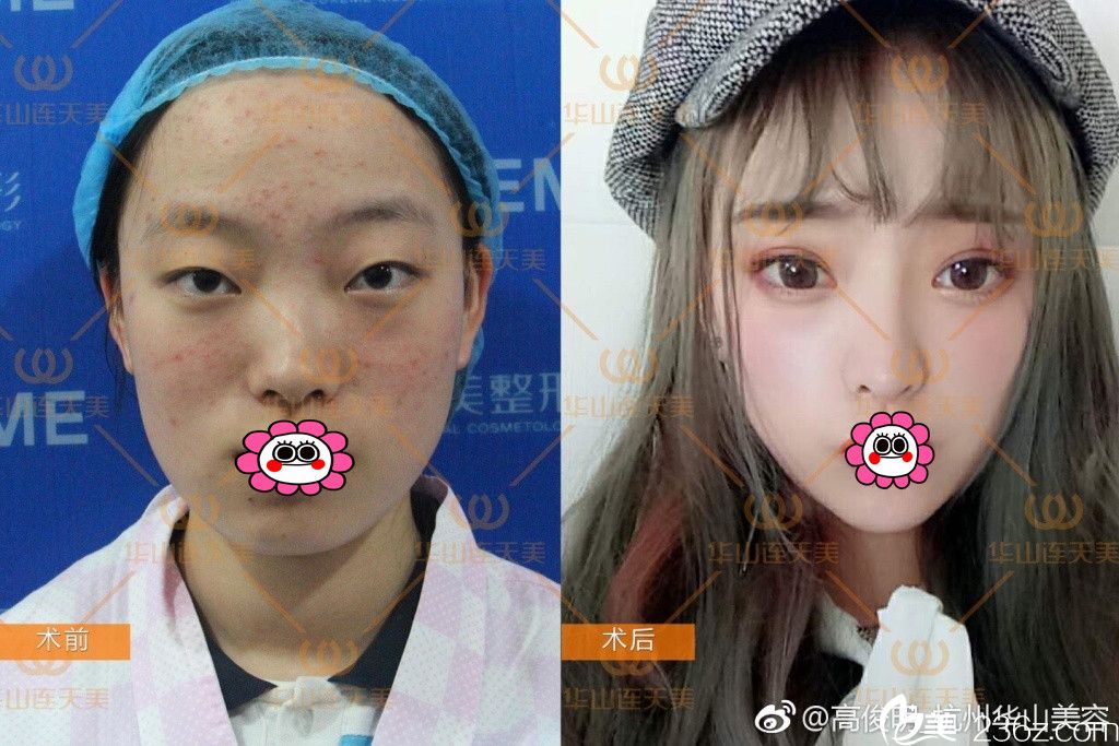 杭州連天美雙眼皮案例