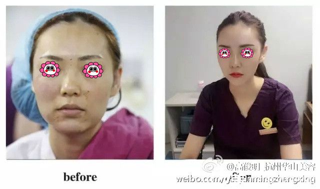 連天美玻尿酸注射效果圖