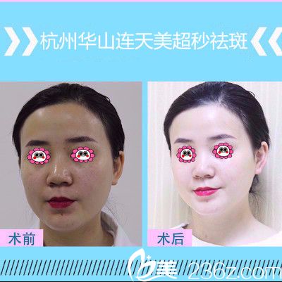 我在連天美祛斑變化圖