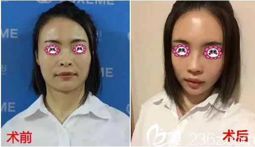 杭州連天美隆鼻前后對比照