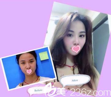 海南蘭顏慧醫(yī)學(xué)美容醫(yī)院鼻綜合真人前后對(duì)比