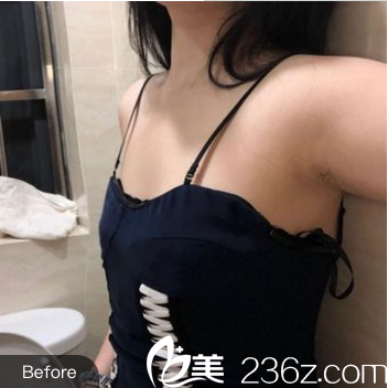 術前平胸照片 術前平胸照片