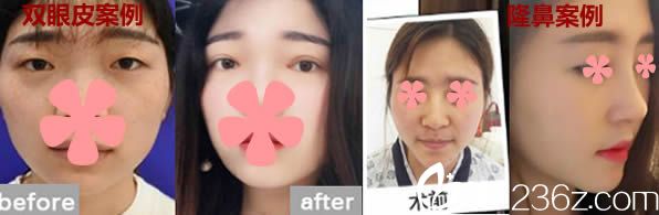 福州瑪恩徐杰醫(yī)生雙眼皮及鼻綜合隆鼻案例 福州瑪恩徐杰醫(yī)生雙眼皮及鼻綜合隆鼻案例