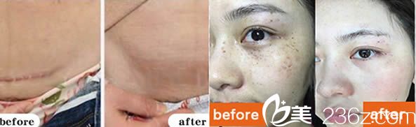 福州瑪恩劉劍剖腹產(chǎn)祛疤痕案例及激光祛斑前后對比效果 福州瑪恩劉劍剖腹產(chǎn)祛疤痕案例及激光祛斑前后對比效果