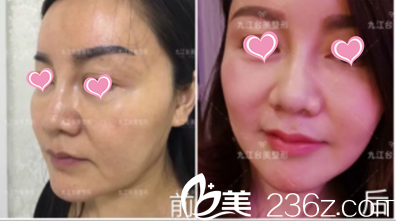 即刻效果對比圖