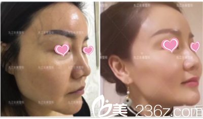 九江臺美治療真人案例全程展示：擺脫法令紋、蘋果肌下垂、無懼年齡變更美