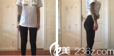 大腿吸脂4天后正面?zhèn)让嬲掌? alt=