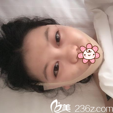 面部吸脂術(shù)后即刻 面部吸脂術(shù)后即刻