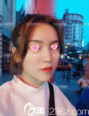 九江臺(tái)美美容整形醫(yī)院注射瘦臉效果