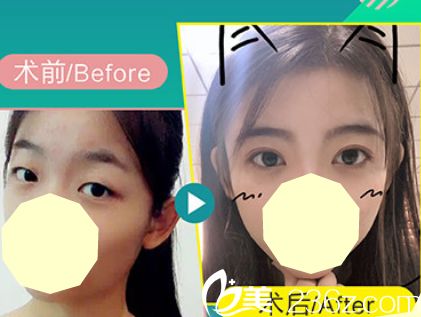 真人案例及反饋見證合肥美舒雅整形怎么樣 再看美舒雅整形價格表心動變行動