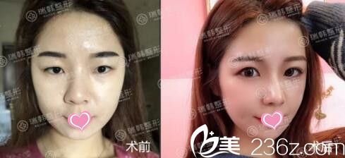 眼綜合真人前后效果對比照 眼綜合真人前后效果對比照