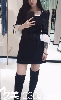 <i data-id='82eb1d34-6b77-4d6f-a381-8bd7586dfd21' style='display:none;'></i>大腿小腿吸脂術(shù)后2個月照片 <i data-id='82eb1d34-6b77-4d6f-a381-8bd7586dfd21' style='display:none;'></i>大腿小腿吸脂術(shù)后2個月照片