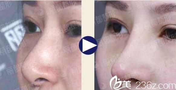 到無錫麗都做合資假體隆鼻案例對比 到無錫麗都做合資假體隆鼻案例對比