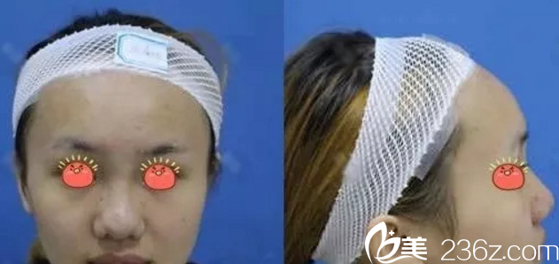 我在桂林華美做鼻綜合手術(shù)前 我在桂林華美做鼻綜合手術(shù)前